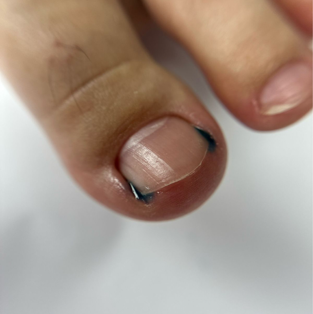 Подологическая обработка ногтей 2500-4000