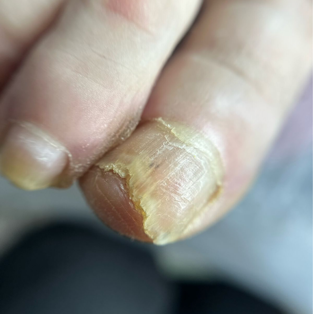 Обработка онихомикоза 1ед 2000-3500