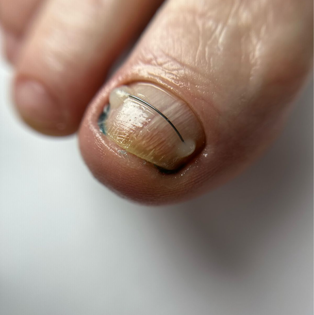 Коррекционная система титановая нить