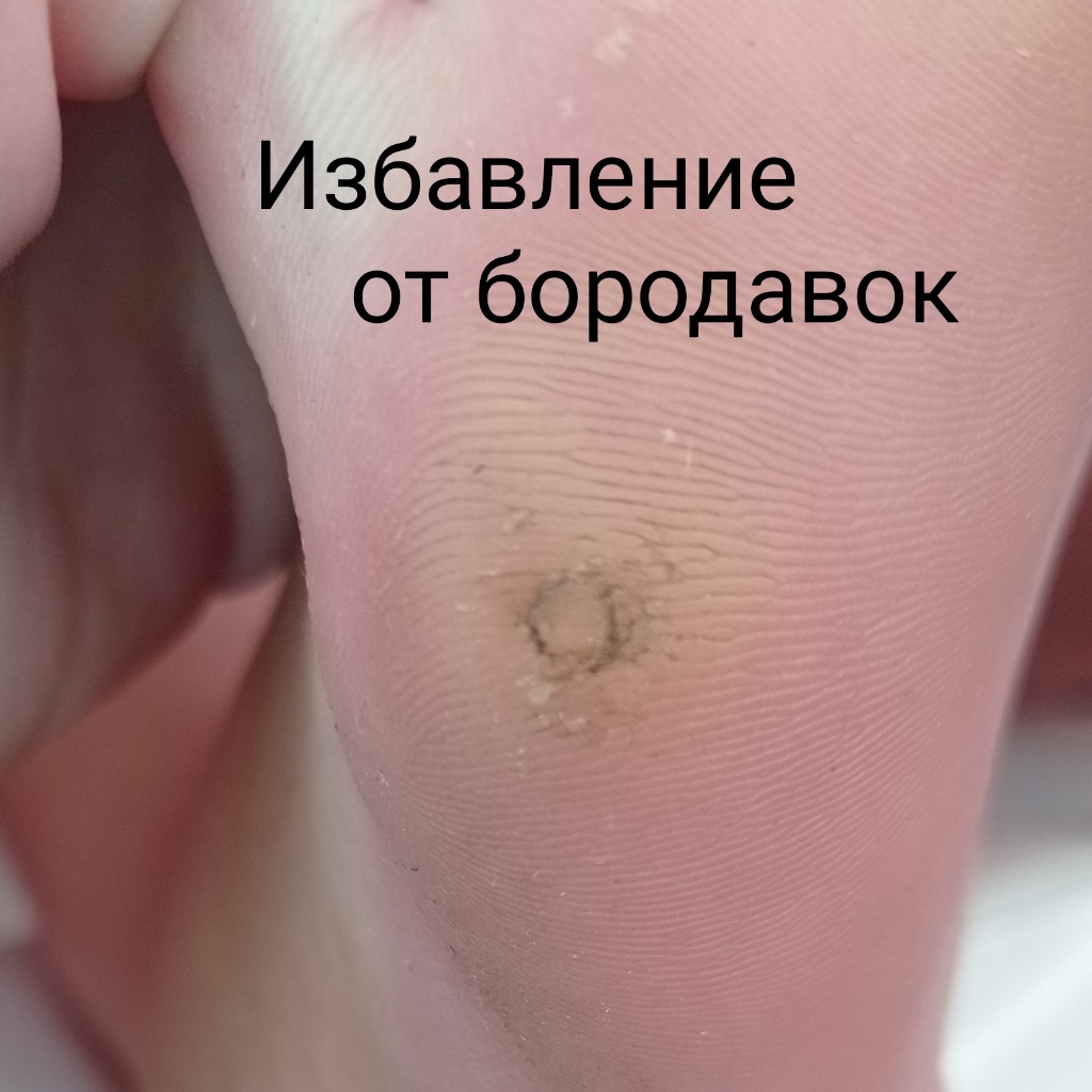 Работа с бородавками