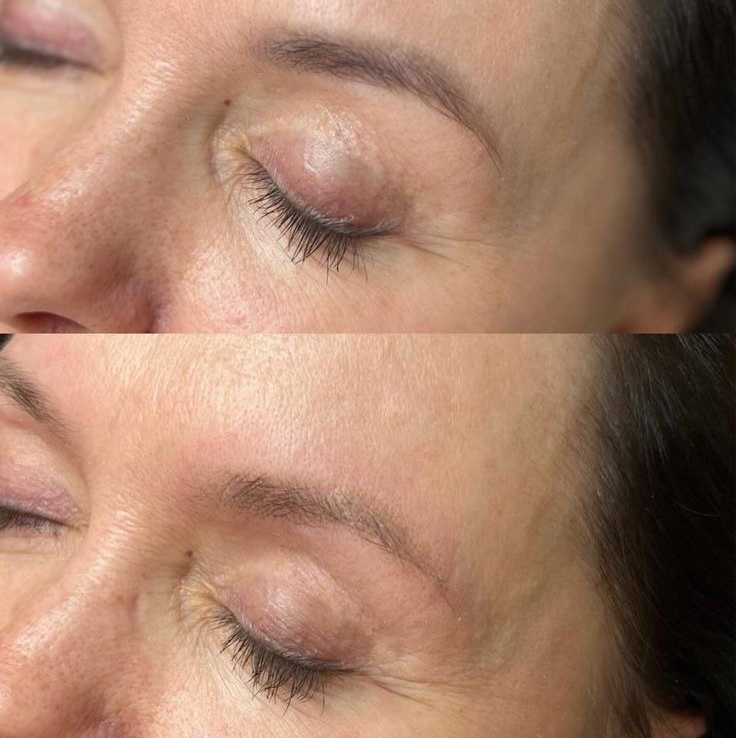 Удаления перманента ремувером