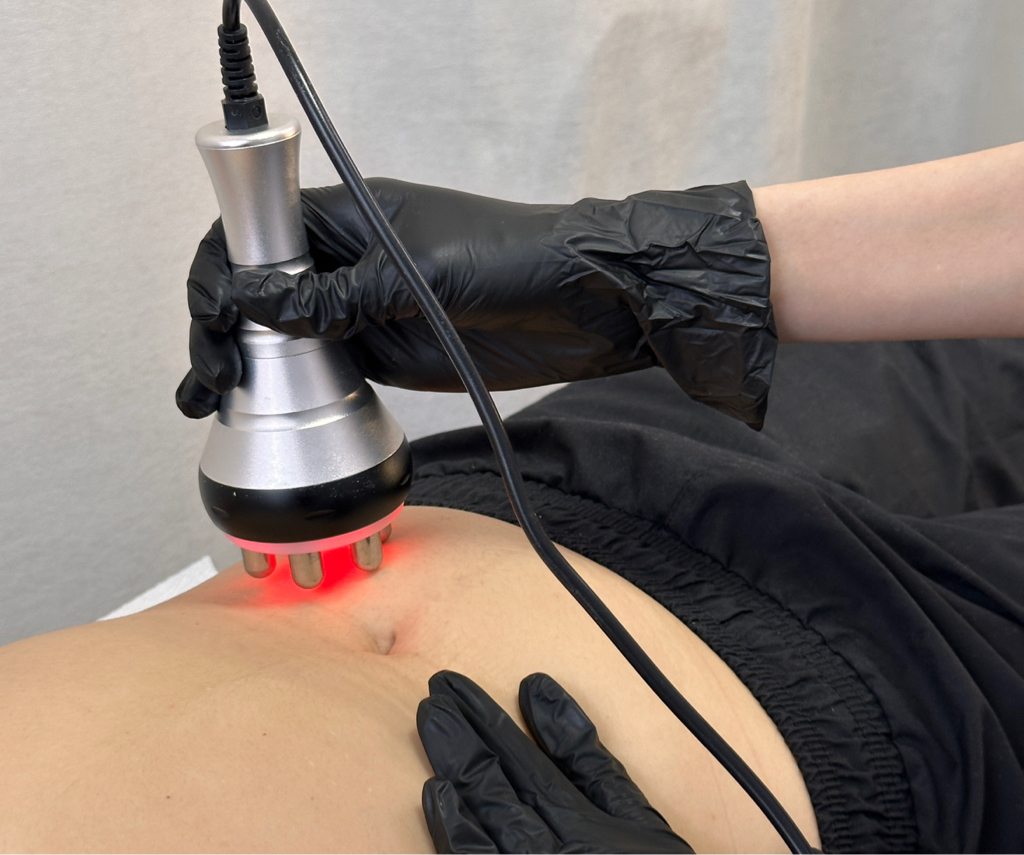 Rf лифтинг тела(1 зона)