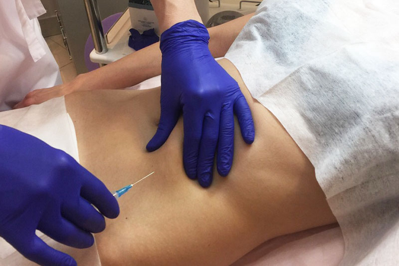 Мезотерапия спины неинвазивная