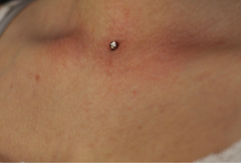 Установка микродермала