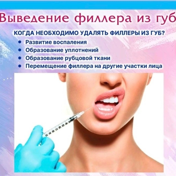 Выведение филлера