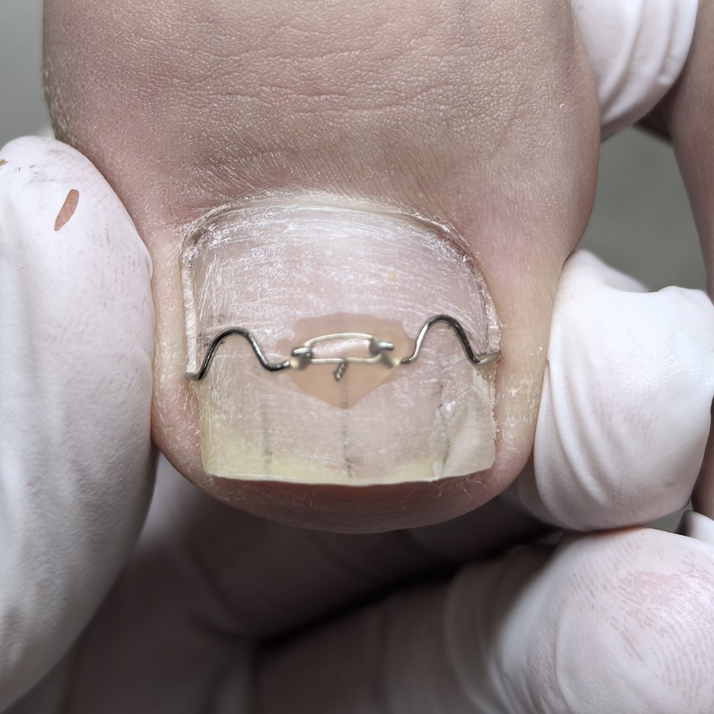 установка скобы 3ТО