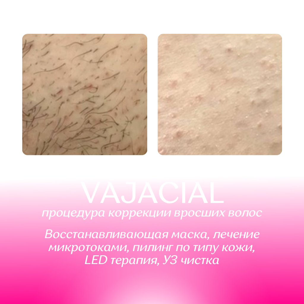 VAJACIAL