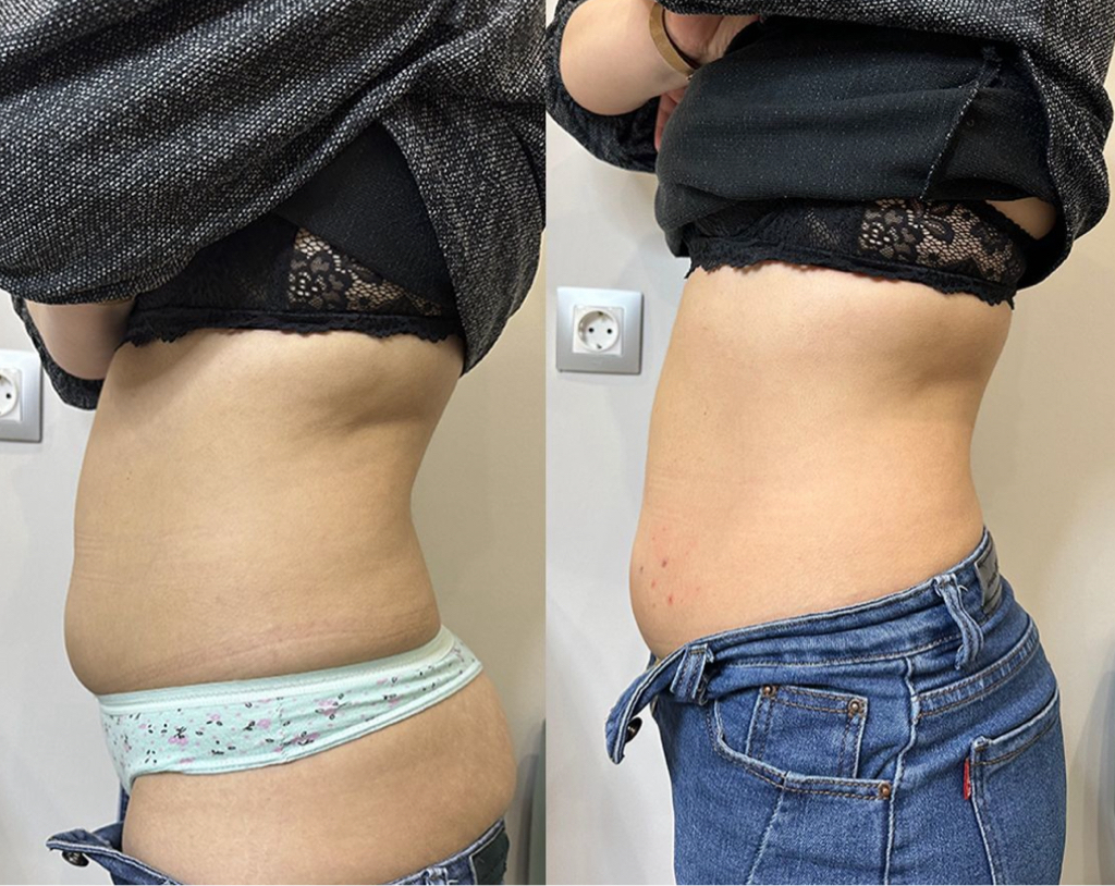 Липолитики