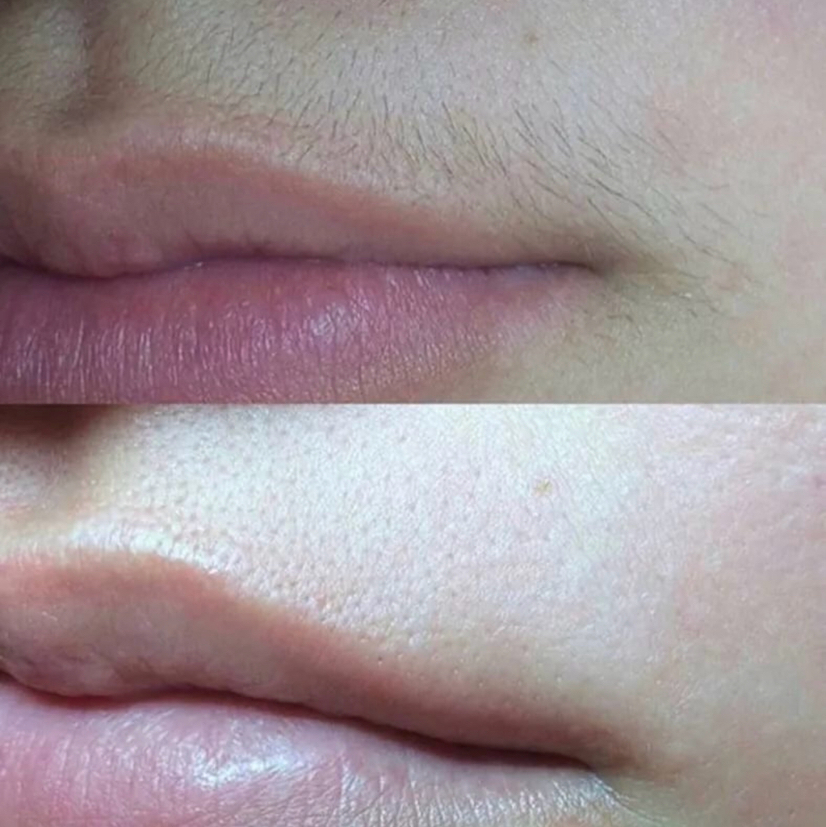 Волосы над верхней губой