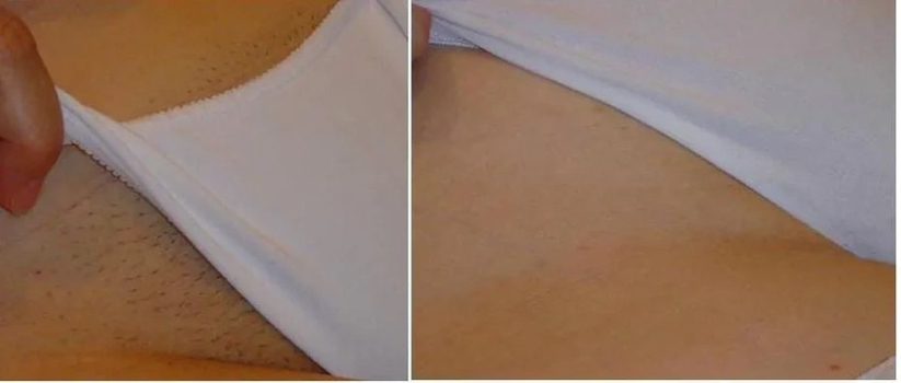 Классическое бикини