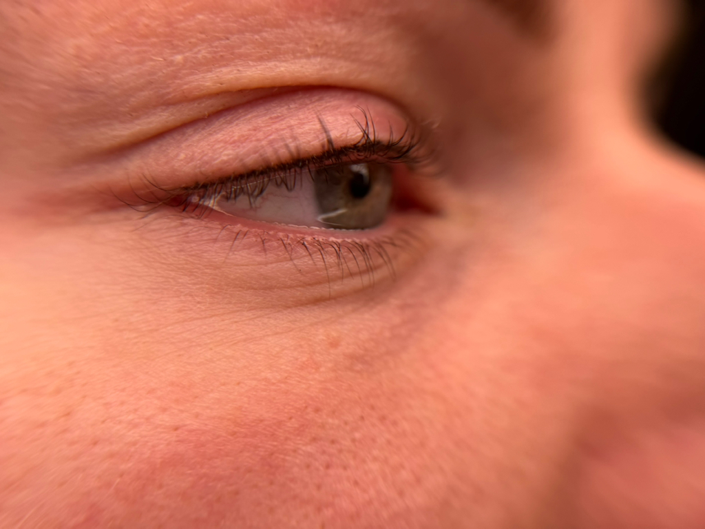 Межресничка