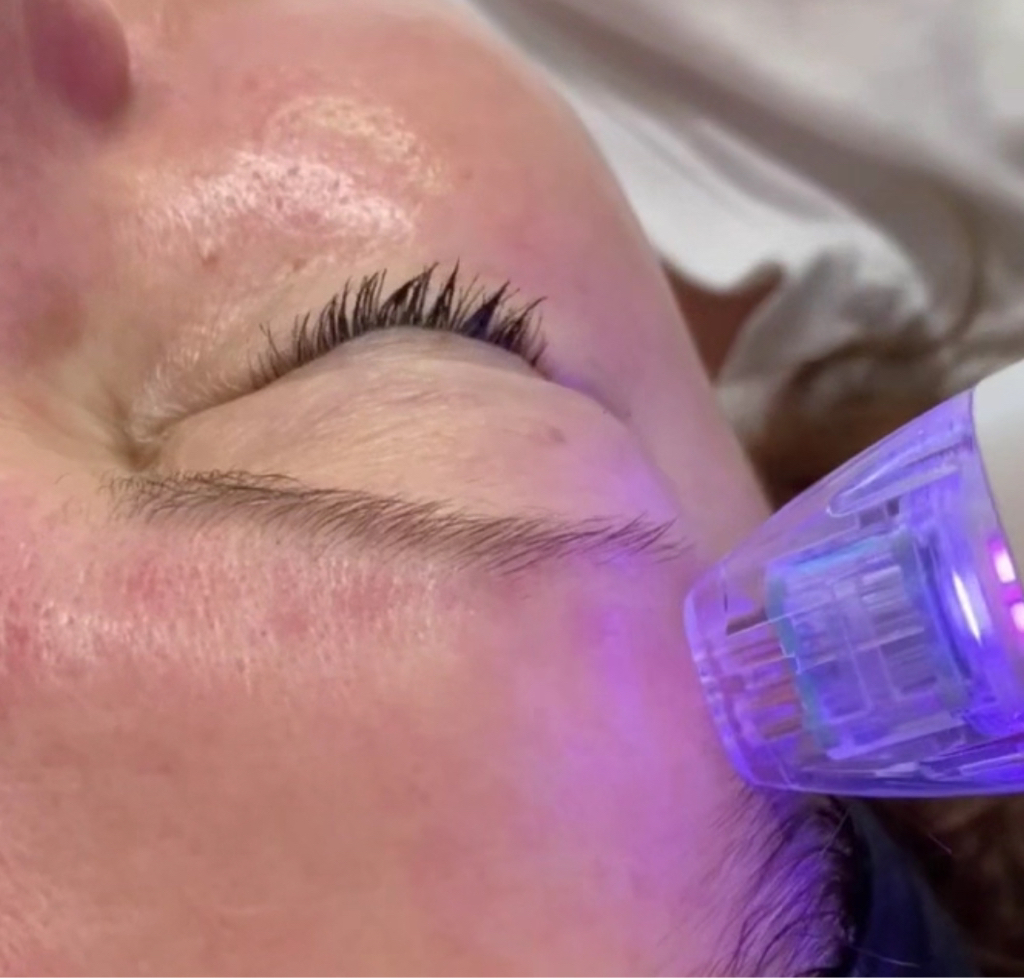 Микроигольчатый рф лифтинг Лицо, шея, декольте