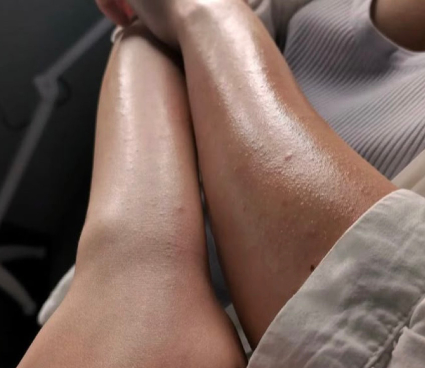 Шугаринг, восковая депиляция зоны рук до локтя