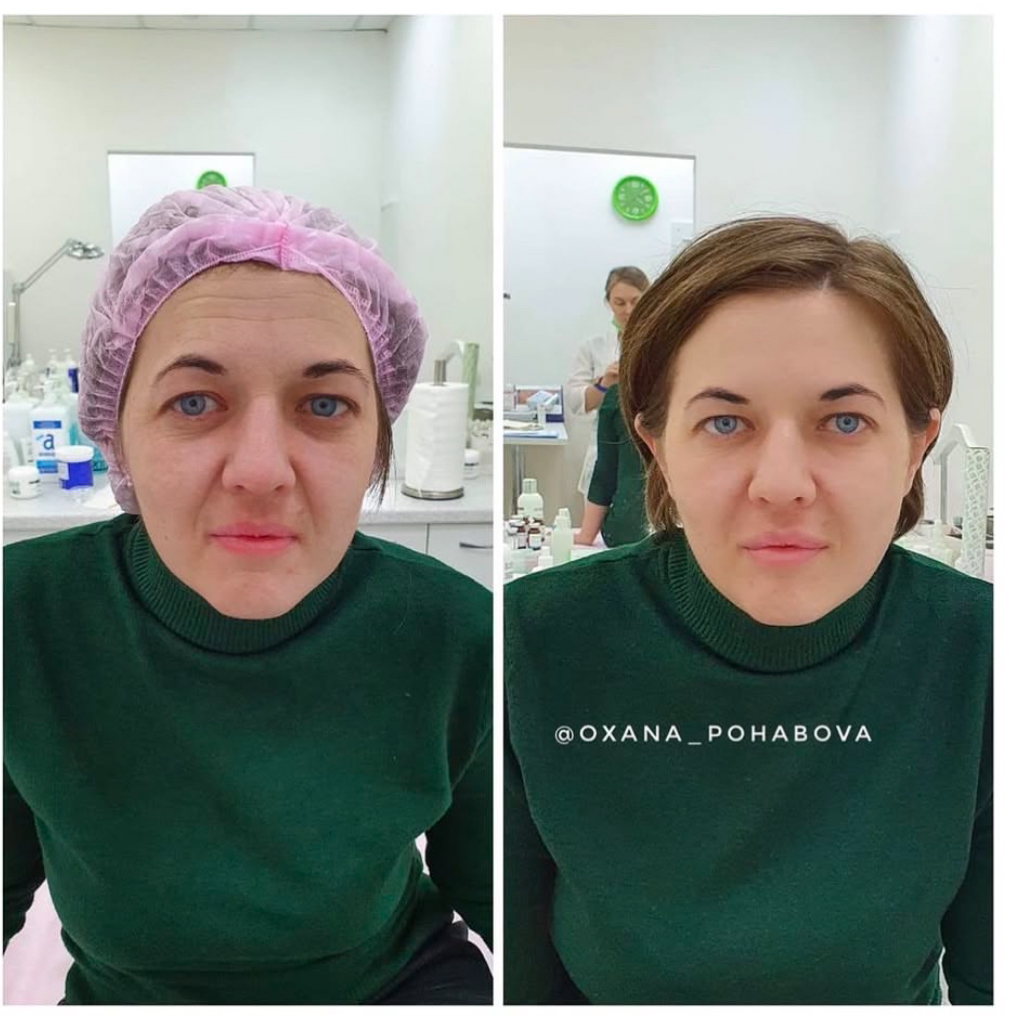 Ботокс