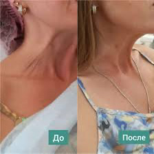 Лифтинг Нефертити