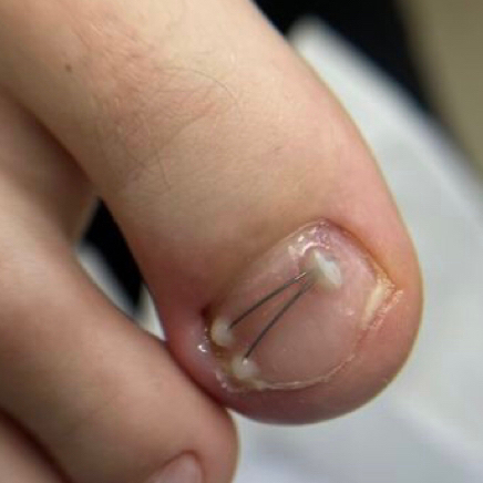 Исправление вросшего ногтя