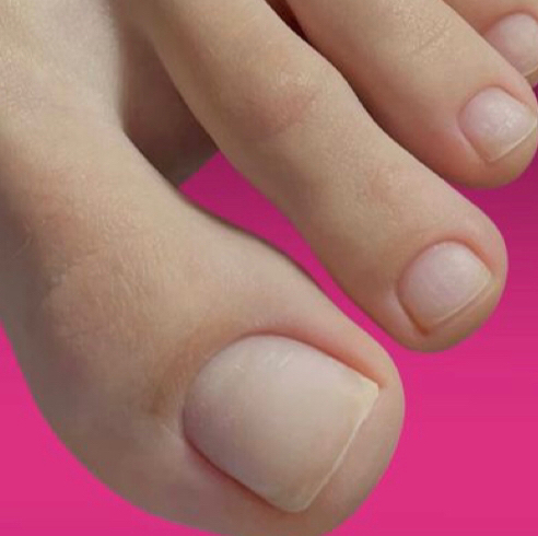 Консультация (вросший ноготь)