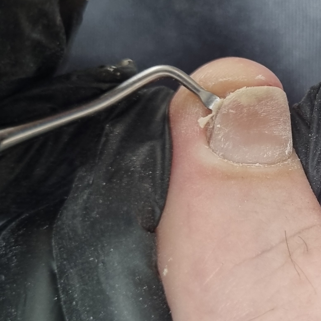 обработка вросшего ногтя