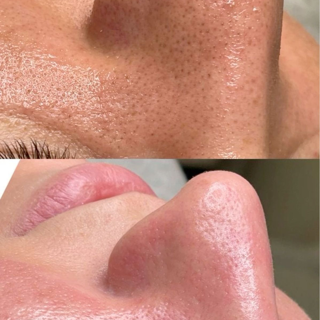 Чистка лица (механическая)