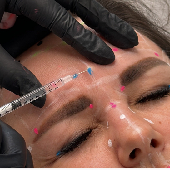 Верхняя треть | межбровье + лоб Ботулинотерапия | BOTOX