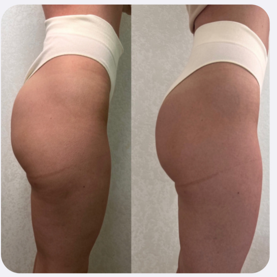 Подтяжка ягодиц ботулотоксином Ботулинотерапия | BOTOX