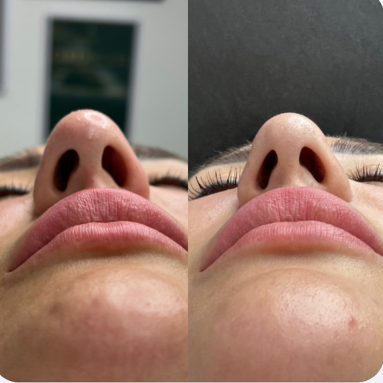 Сужение и поднятие кончика носа Ботулинотерапия | BOTOX