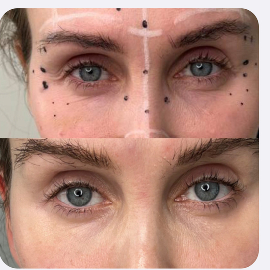 Эффект лисьих глазок Ботулинотерапия | BOTOX
