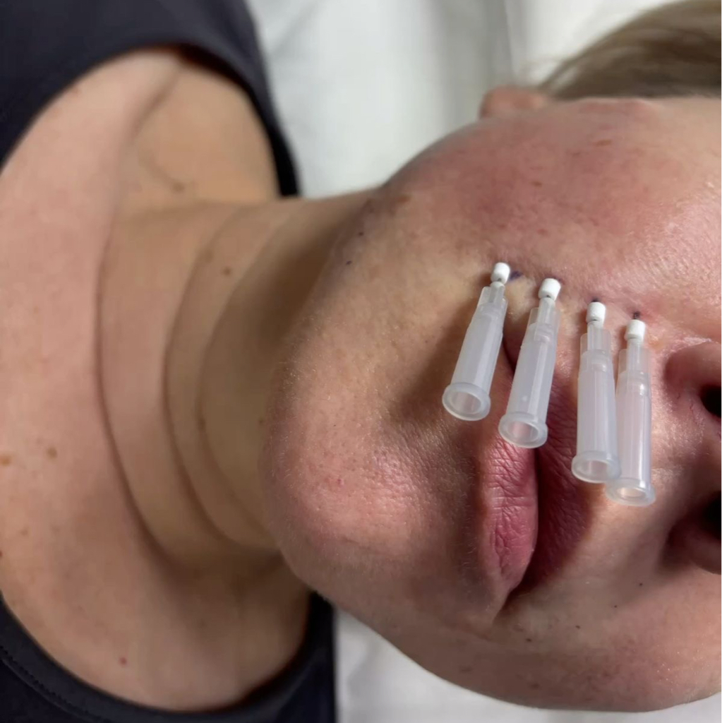 Моно нити (PDO,PLC)