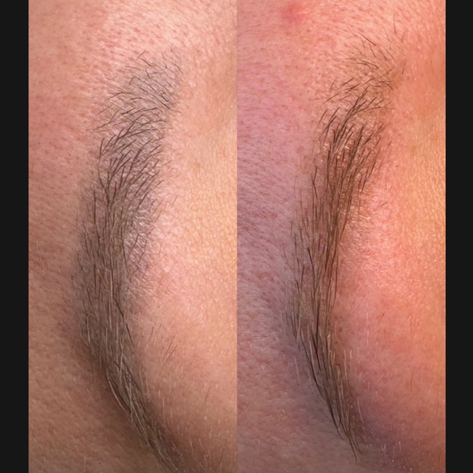 Удаление перманентного макияжа лазером