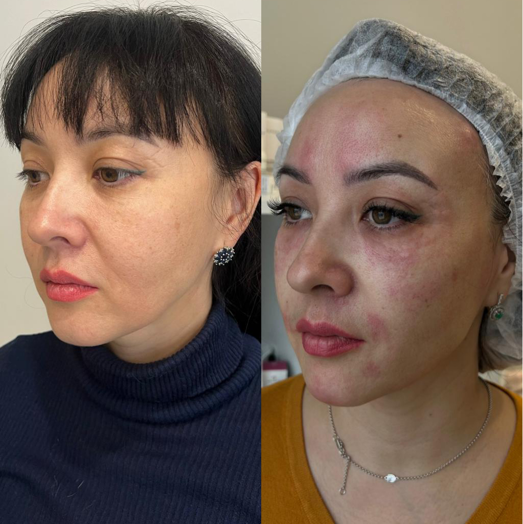 Нитевая имплантология.Нити для уплотнения кожи