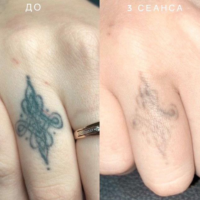 Удаление татуировку