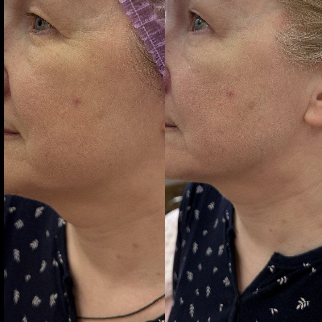 Карбоновый пилинг