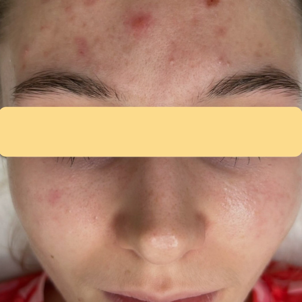 Пилинг Джесснера /ТСА