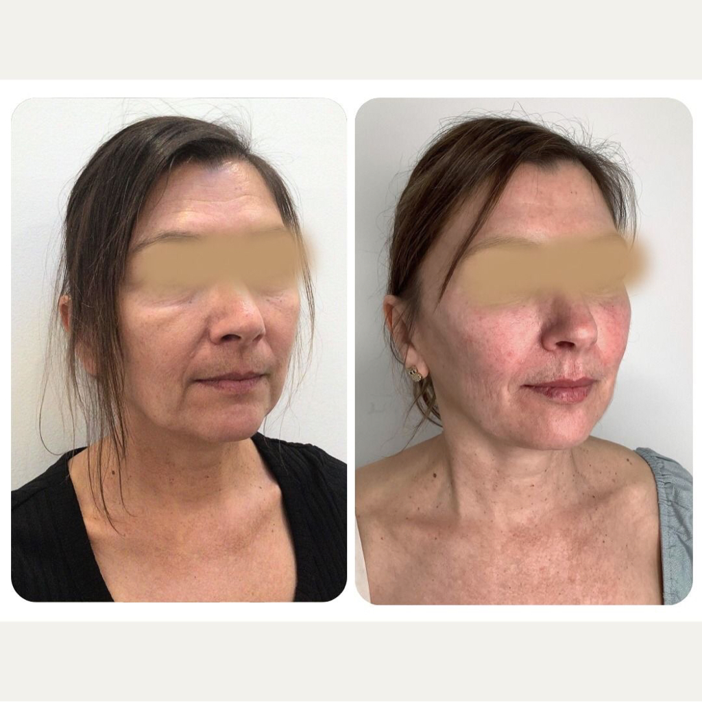 Абонемент на 3 сеанса омоложения экзосомами