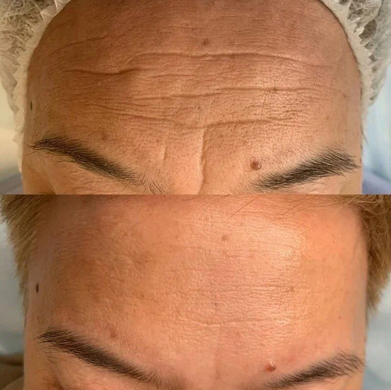 Брашинг морщин препаратом belotero balance 1,0 ml