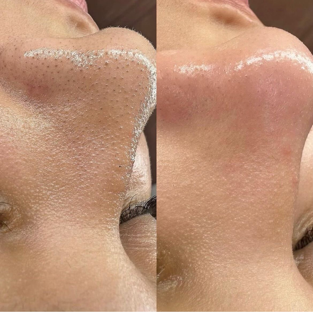 Комбинированная чистка лица