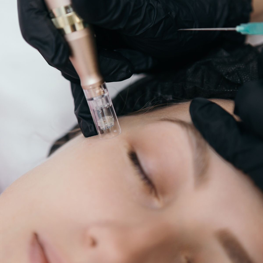 Микронидлинг (безинъекционная мезотерапия)