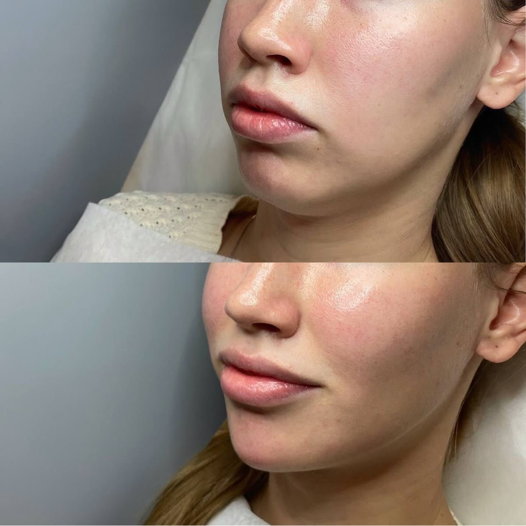 Контурная пластика подбородка / скул 1 мл