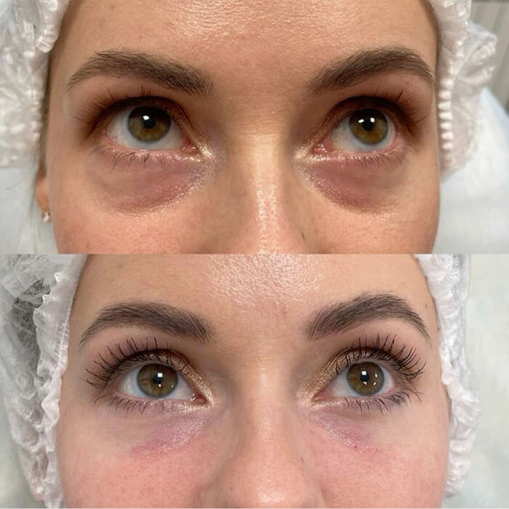 Биоревитализация глаз MESOEYE C71