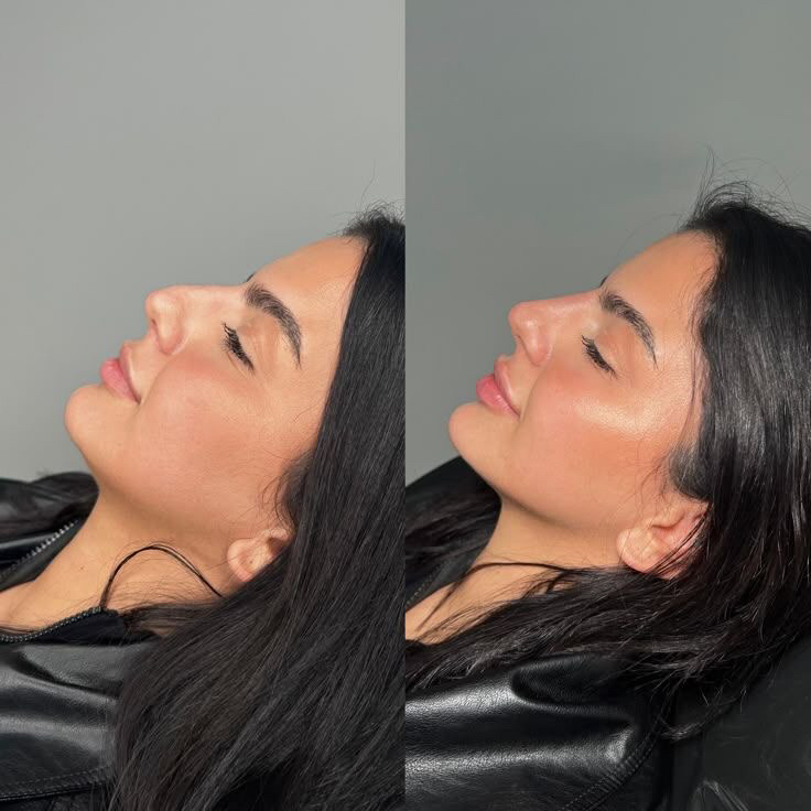 Биолифтинг PLLA Reborn