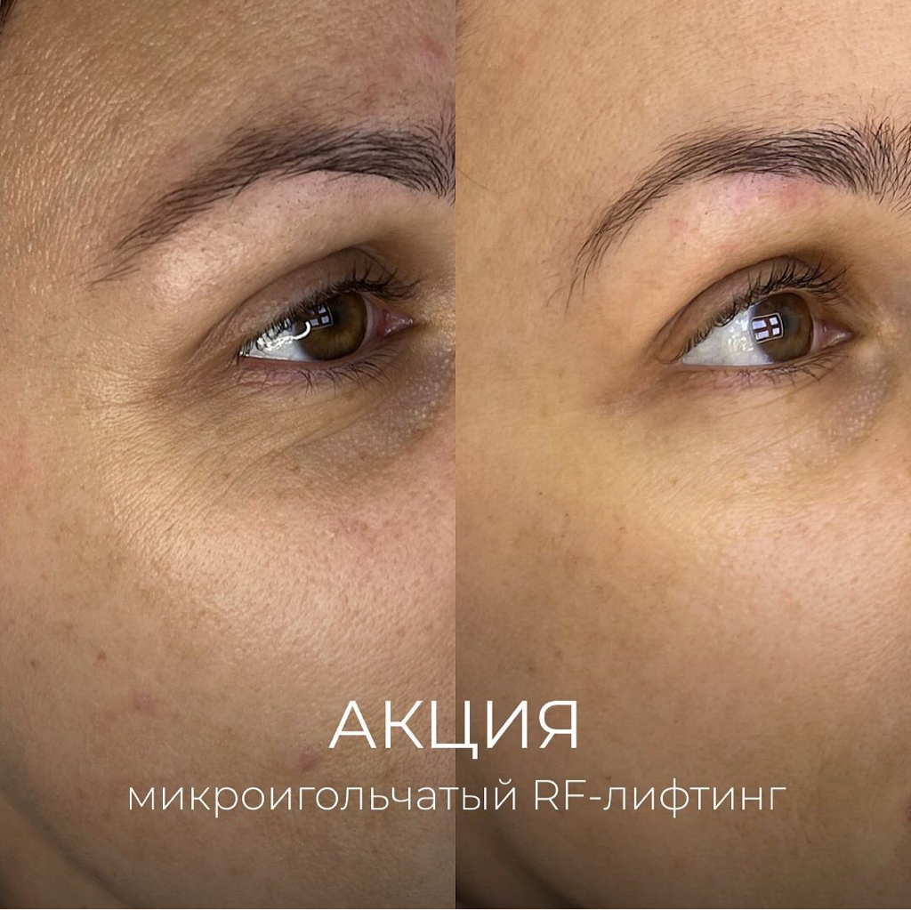 Абонемент на 3 сеанса микроигольчатольго RF лифтинга INMODE