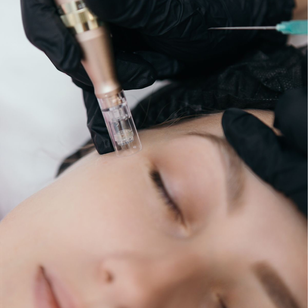 Абонемент на 4 сеанса микронидлинга