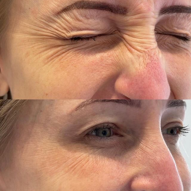 Ботулотоксин от морщин с сохранением мимики