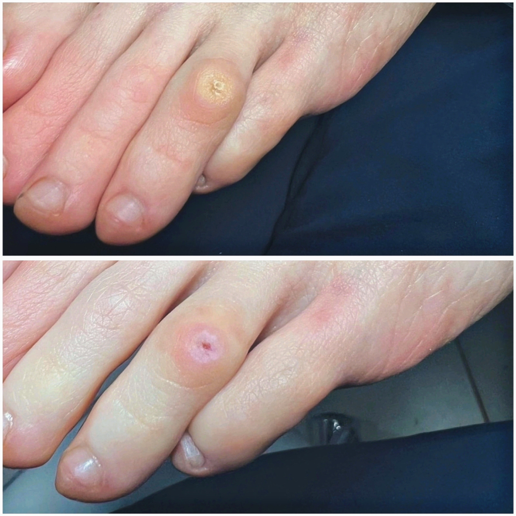 Обработка стержневых мозолей