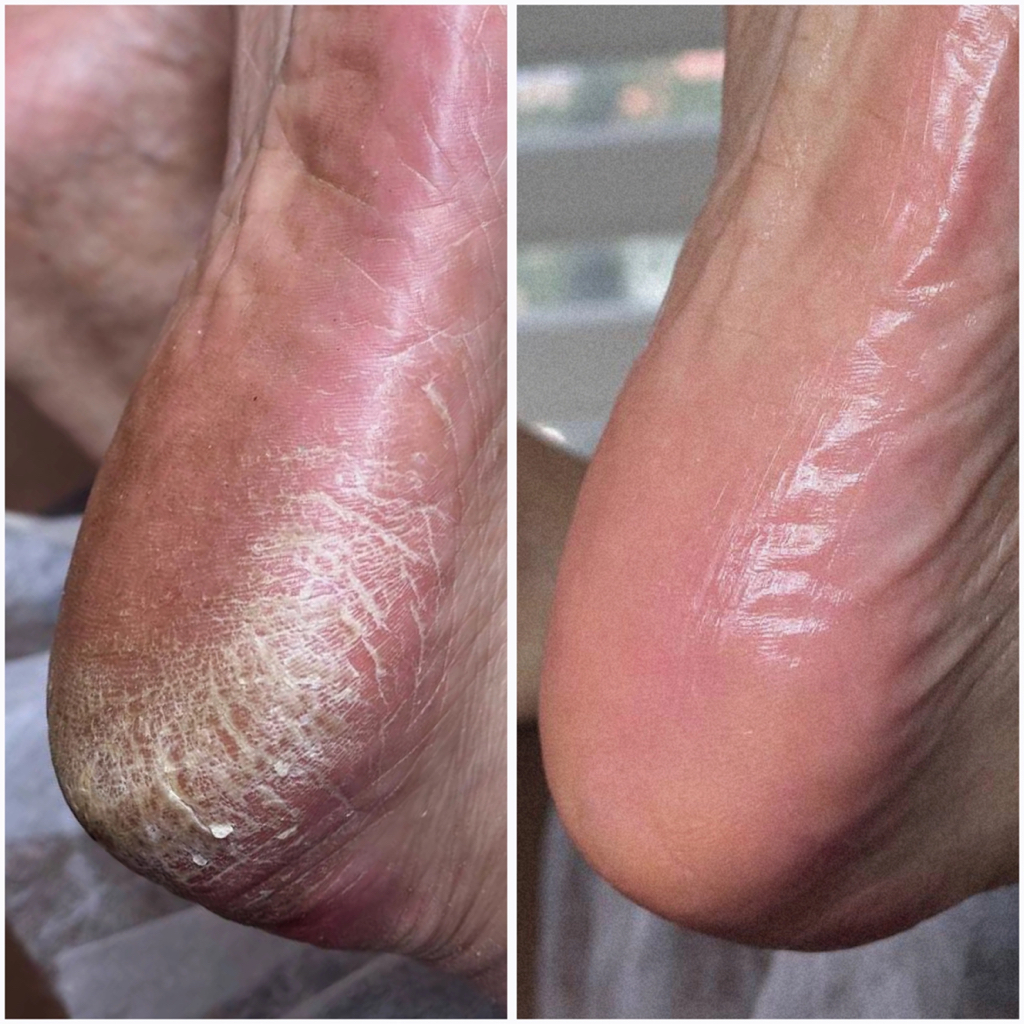 Обработка проблемной стопы