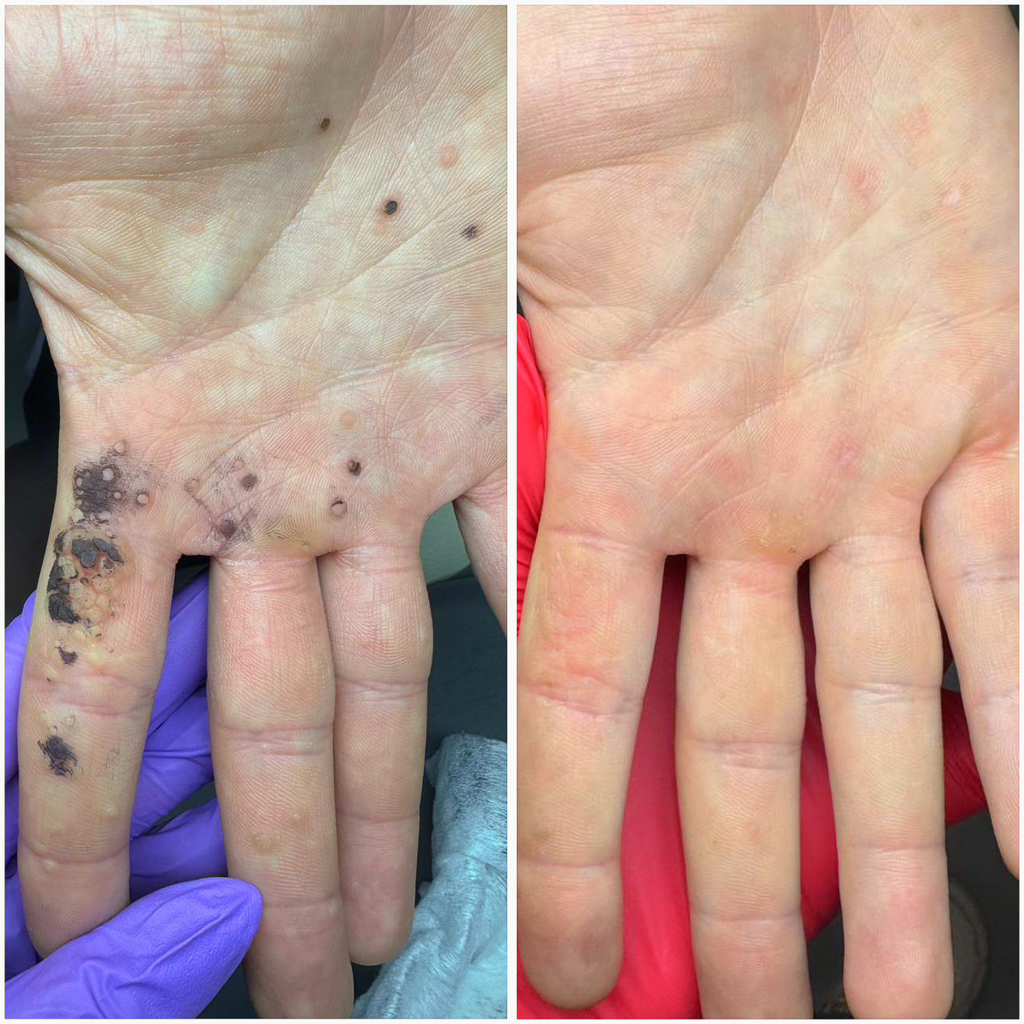 Обработка бородавок на руках