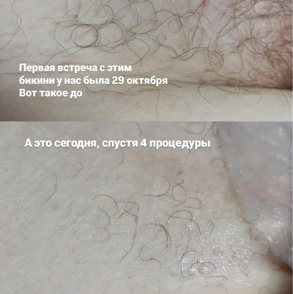 Электроэпиляция