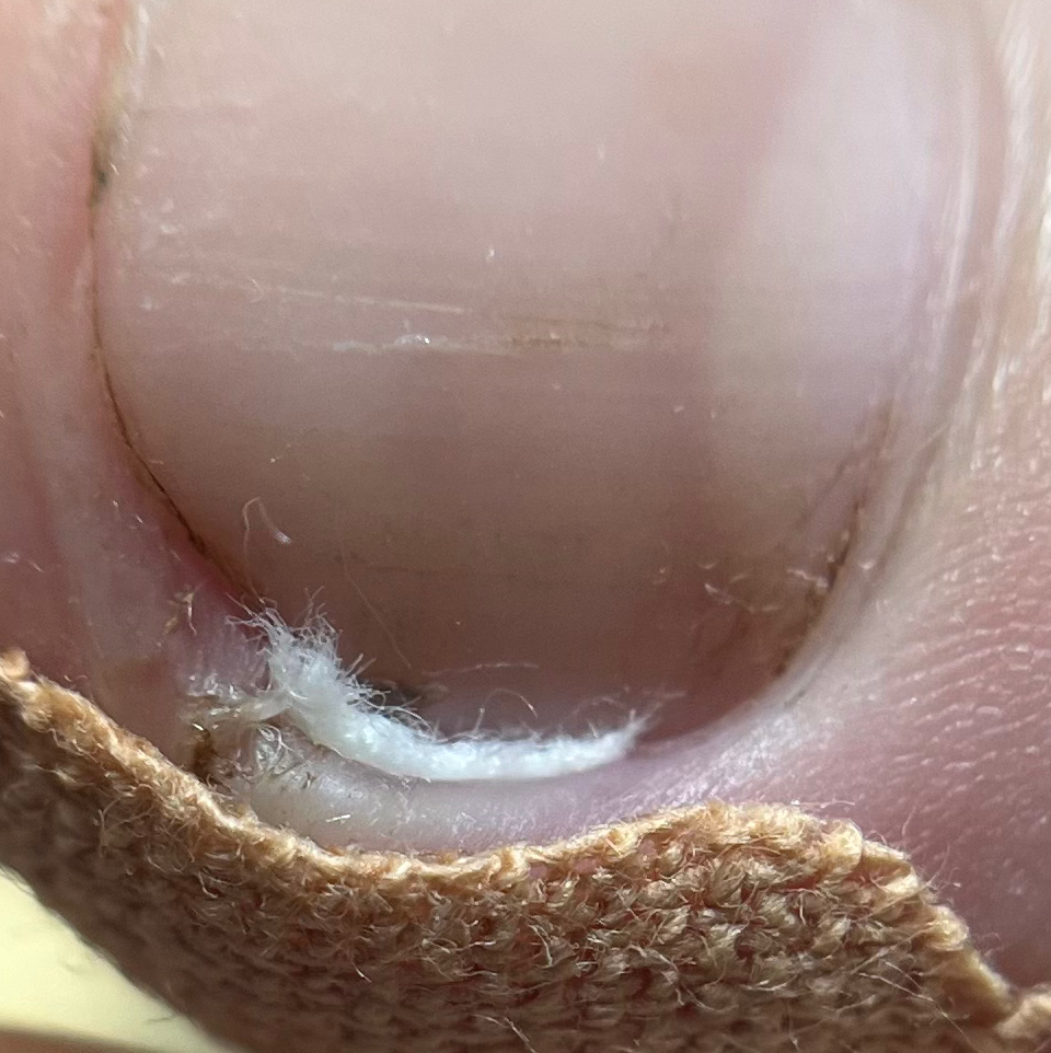 Тампонирование боковых валиков