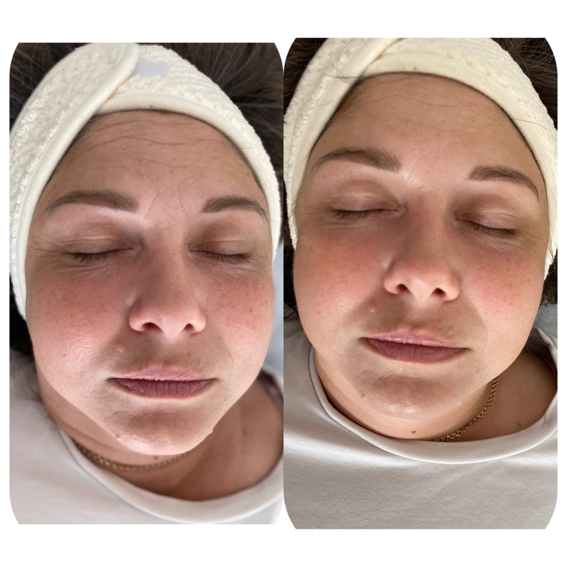 Фото омоложения лицо +шея