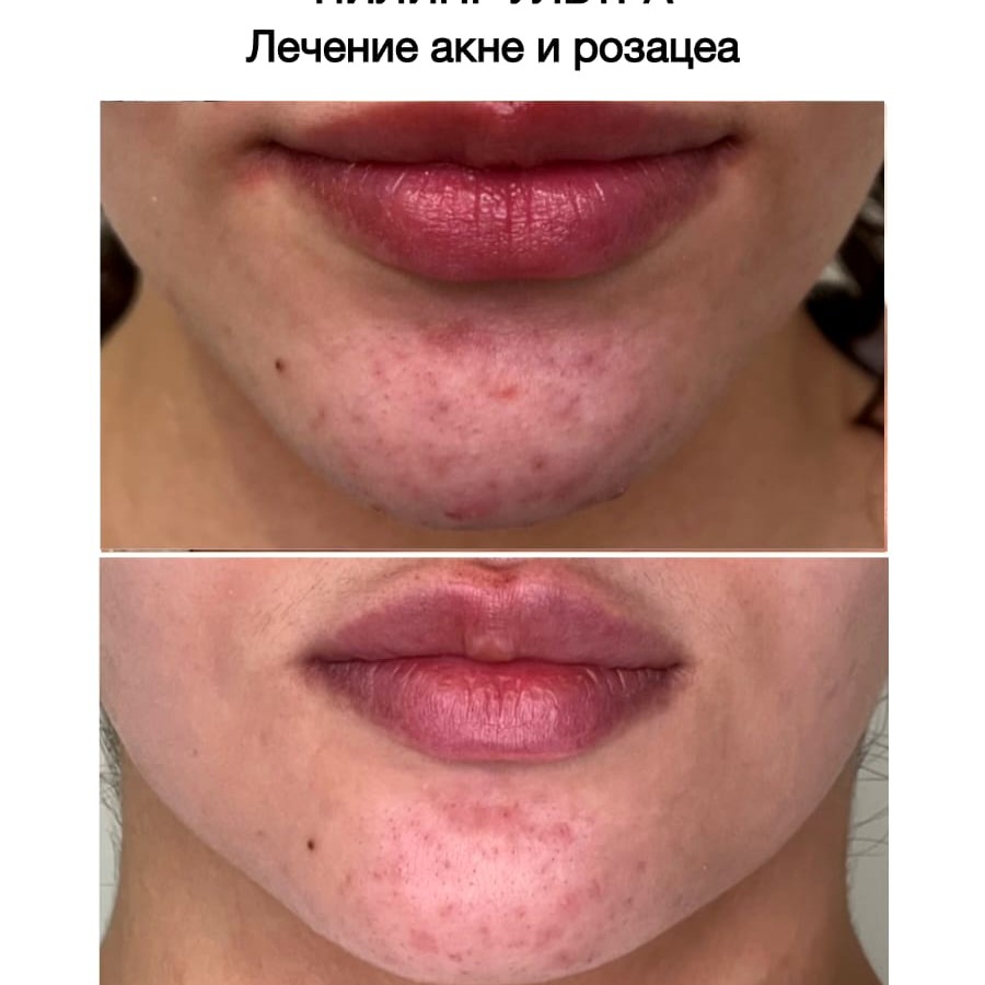 Пилинг Ультра для проблемной кожи